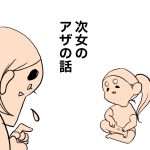 次女のアザの話